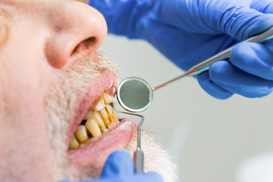 Bad teeth and mouth mirror. Dental examination close up.