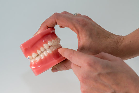 A view of a dentist Typodont (a mouth simulator) used for orthodontic treatment planifications
