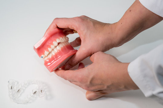 MADRID, SPAIN - FEBRUARY 10, 2017: A view of a dentist Typodont (a mouth simulator) used for orthodontic treatment planifications with a set of transparent aligners