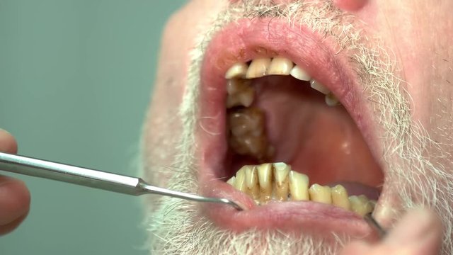 Patient of dentist, bad teeth. Opened mouth and dental probe. How to cure caries.