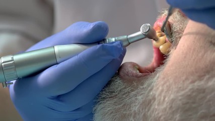 Dentist cleaning teeth of patient. Sick yellow teeth. Oral hygiene maintenance.