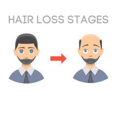 Information chart of hair loss stages types of baldness illustrated on male head vector.