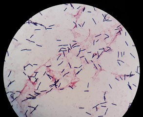 Smear of human blood culture Gram's stained with gram positive bacilli bacteria, under 100X light...