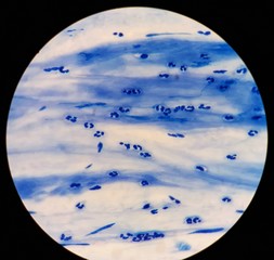 Smear of Acid-Fast bacilli (AFB) stained from sputum specimen, under 100X light microscope.