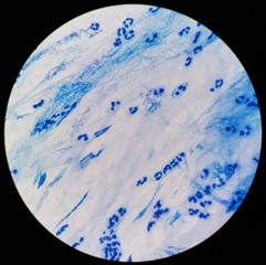 Smear of Acid-Fast bacilli (AFB) stained from sputum specimen, under 100X light microscope.