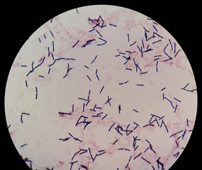 Smear of human blood culture Gram's stained with gram positive bacilli bacteria, under 100X light...