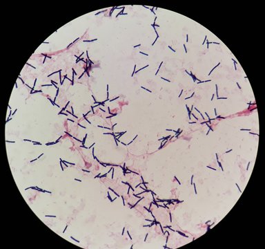 Smear of human blood culture Gram's stained with gram positive bacilli bacteria, under 100X light microscope.