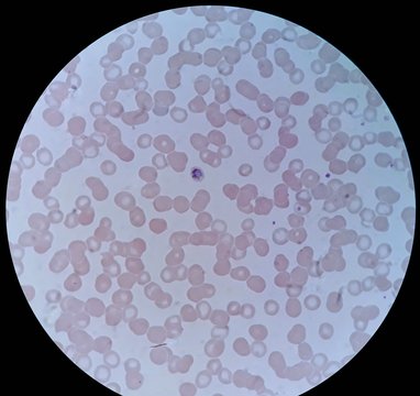 Human parasite under 100X light microscope; thin film of blood smear with trophozoite form malaria infected red blood cell, belong to Plasmodium malariae infection.