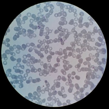 Human parasite under 100X light microscope; thin film of blood smear with ring forms malaria infected red blood cells, belong to Plasmodium falciparum infection.
