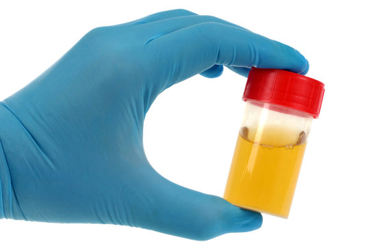 Flacon d'urine pour analyse tenu par une main gant&eacute;e de latex