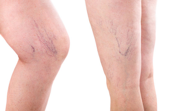 Leg. Legs With Varicose Spider Veins