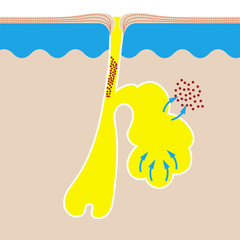 Acne vulgaris or pimple formation process