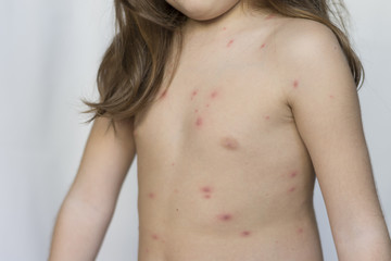 Fototapeta na wymiar Varicella virus or Chickenpox bubble rash on child, baby or adoult