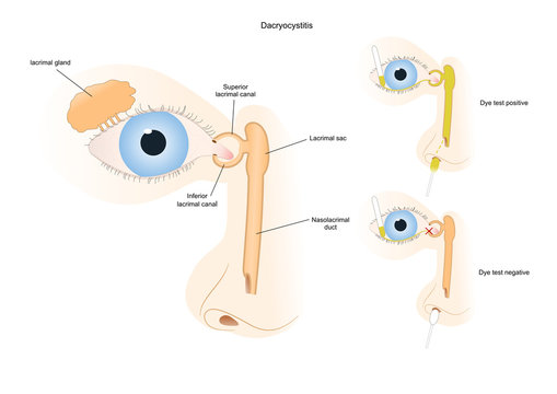 dacryocystitis, an infection of the lacrimal sac (eye), with a test to check if there is an obstruction