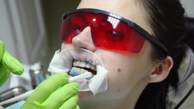 Young woman with an expander in mouth at the dental clinic. Application of protective whitening gel to the teeth. Dentist using saliva ejector or dental pump to evacuate saliva. Shot in 4k