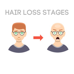 Information chart of hair loss stages types of baldness illustrated on male head vector.