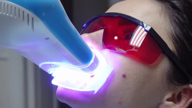 Young woman with an expander in mouth and red protective glasses getting UV whitening at the dentist's office by an ultra violet machine. Shot in 4k