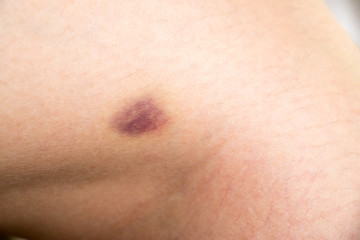 Naklejka premium Closed up of bruised injury on woman leg background