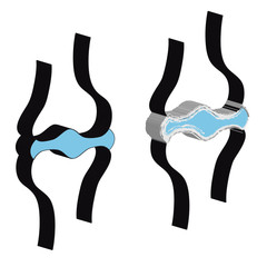 Naklejka premium 3D Joint with cartilage and arthritis