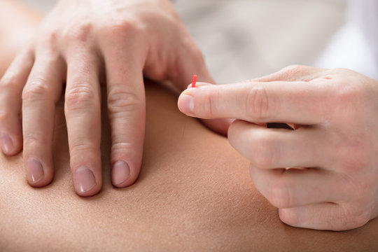 Person Getting An Acupuncture Treatment