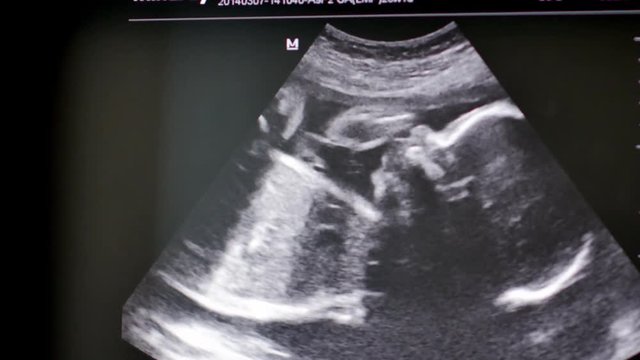 Monitor with medical ultrasound scan of human baby. 4K UltraHD footage