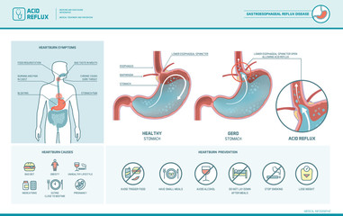 Acid reflux and heartburn infographic - obrazy, fototapety, plakaty