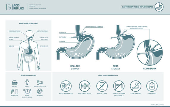 Acid reflux and heartburn infographic