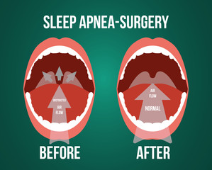 Vector illustration of surgery for obstructive sleep apnea, before and after result.