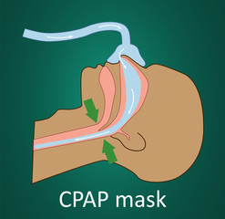 Vector illustration of normal breathing with CPAP mask. 