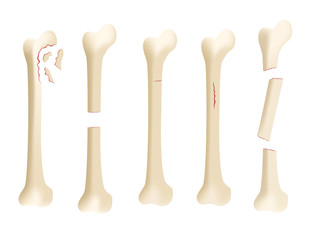 crack human bone vector - obrazy, fototapety, plakaty