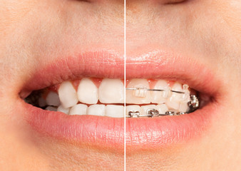 Teeth with and without dental braces full mouth