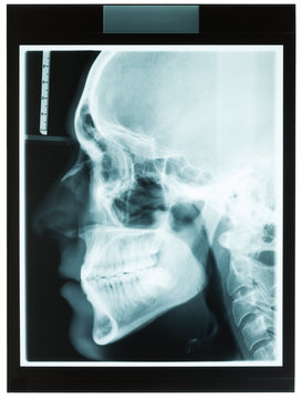 Profile Xray Of Man Jaw For Dentist