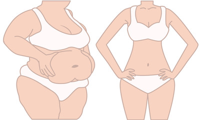 Woman before and after diet weigh loss. Fat and slim woman. Women pinch the stomach. Women weight loss success. 