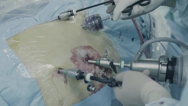 Laparoscopic surgery of the abdomen
