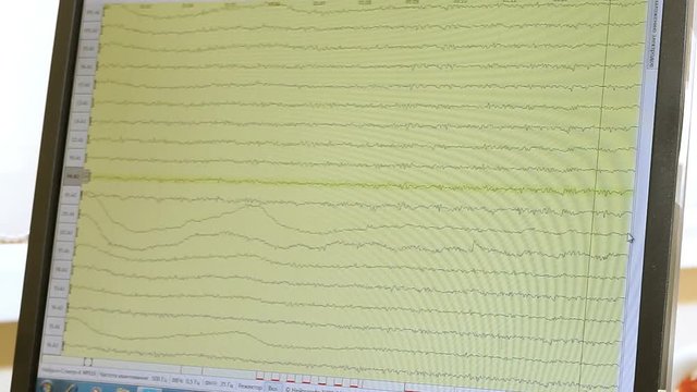 Electroencephalographic examination. Close-up shot of monitor screen with results of monitoring the functions of the human brain. HD
