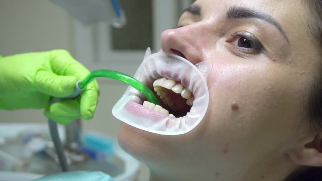 Dentist using saliva ejector or dental pump to evacuate saliva. Young woman with an expander in mouth at the dental clinic. Modern dental office. Shot in 4k