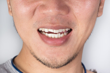 Fototapeta premium ugly smile dental problem. Teeth Injuries or Teeth Breaking in Male. Trauma and Nerve Damage of injured tooth, Permanent Teeth Injury.