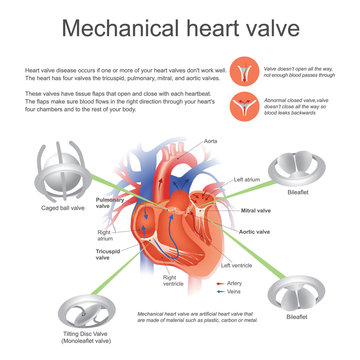 Mechanical heart valve. Vector graphic.