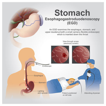 EGD Stomach. Vector graphic.
