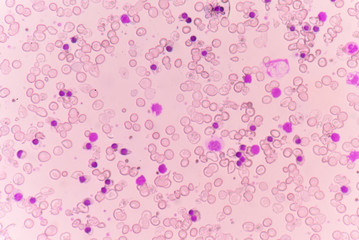 Abnormal red blood cells