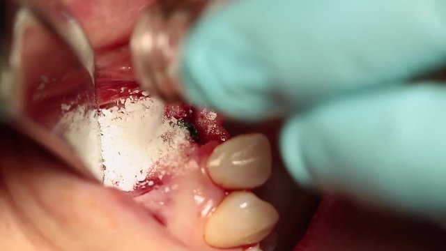 The gingival wall thickness of the bone wall in the jaw, the work of a professional dental surgeon
