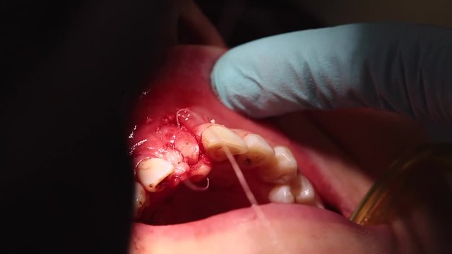 Suturing the gums of the oral cavity after a sine lift, the work of a professional dental surgeon