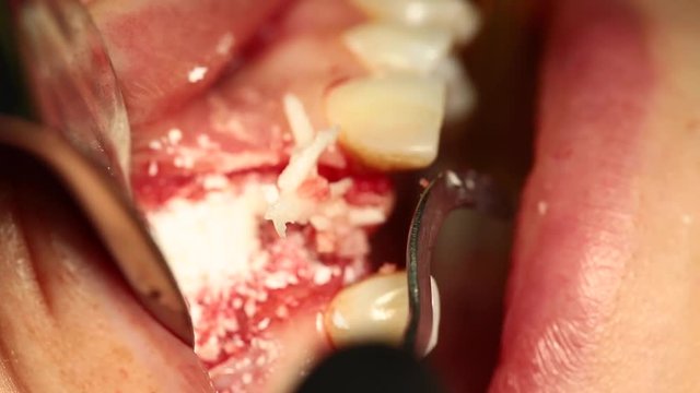 The gingival wall thickness of the bone wall in the jaw with the addition of natural bone