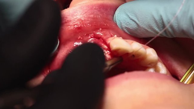 Accurate sewing of the gums of the oral cavity after a sinus lift, the work of a professional dental surgeon, shot on a macro shot