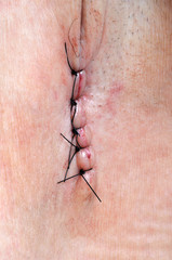 Les points de suture
