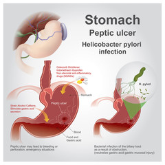 Obraz premium stomach peptic ulcer