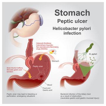 stomach peptic ulcer