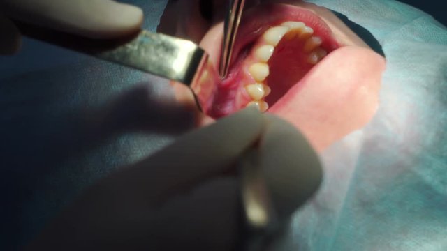 Maxillofacial Surgery, operation
