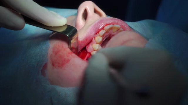 Oral and Maxillofacial Surgery, Polyp removal