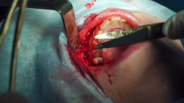 Process of sewing gums in the clinic. Oral and Maxillofacial Surgery.